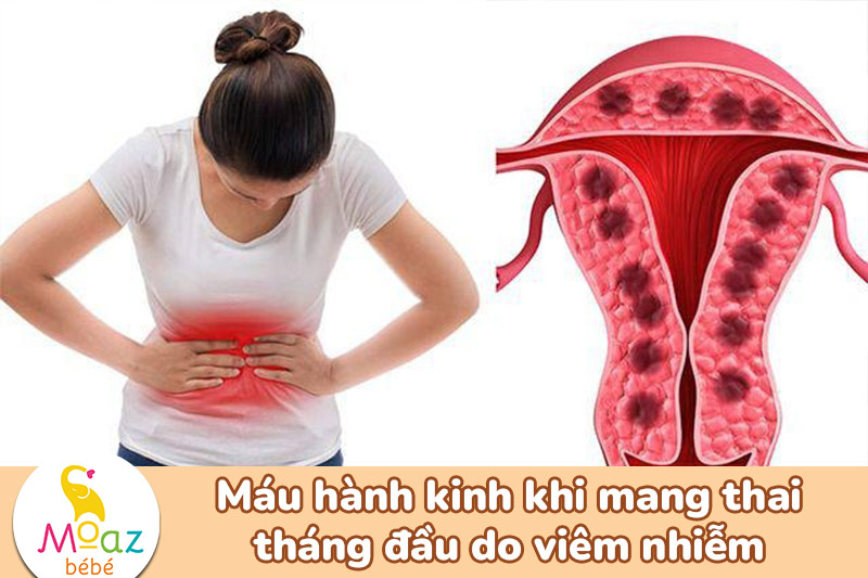 Máu hành kinh khi mang thai tháng đầu do viêm nhiễm phụ khoa