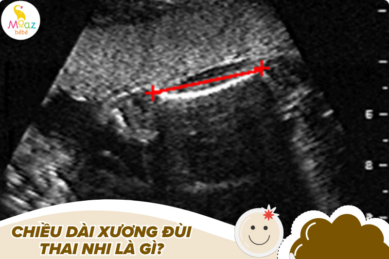 Chiều dài xương đùi thai nhi là gì?