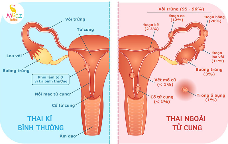 Thai ngoài tử cung là gì?