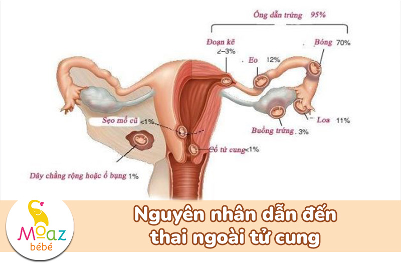 Nguyên nhân dẫn đến thai ngoài tử cung
