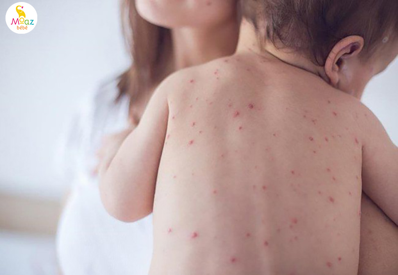 Các bệnh giao mùa thường gặp ở trẻ