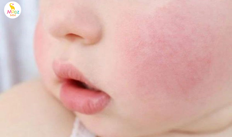 Dấu hiệu trẻ bất dung nạp Lactose dễ nhận biết 6 Phân biệt bất dung nạp lactose và dị ứng đạm sữa bò