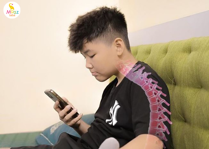 Gù lưng ở trẻ em là gì?