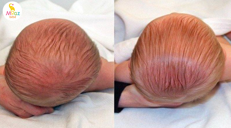 Cách chữa méo đầu cho trẻ 3 tháng tuổi