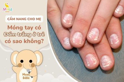 Móng tay có đốm trắng ở trẻ em là hiện tượng gì